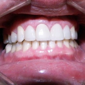 Rehabilitación Oral